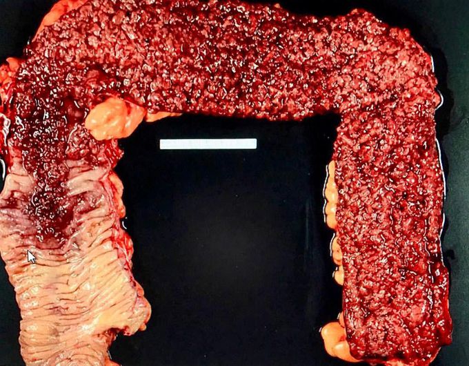 Large intestine affected by extensive Ulcerative colitis