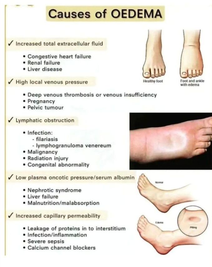 Causes of Edema