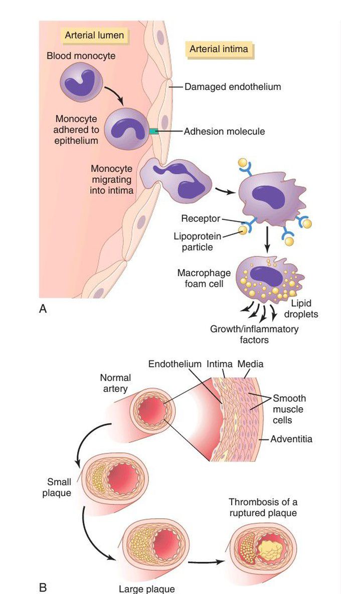 Development of atherosclerotic plaque