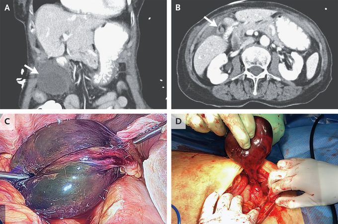 Gallbladder Volvulus