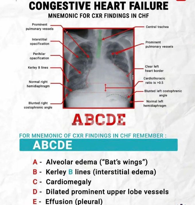 Congestive Heart Failure