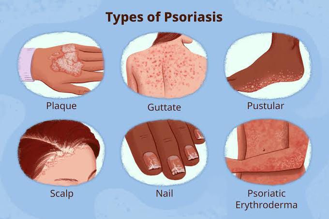 Types of psoriasis