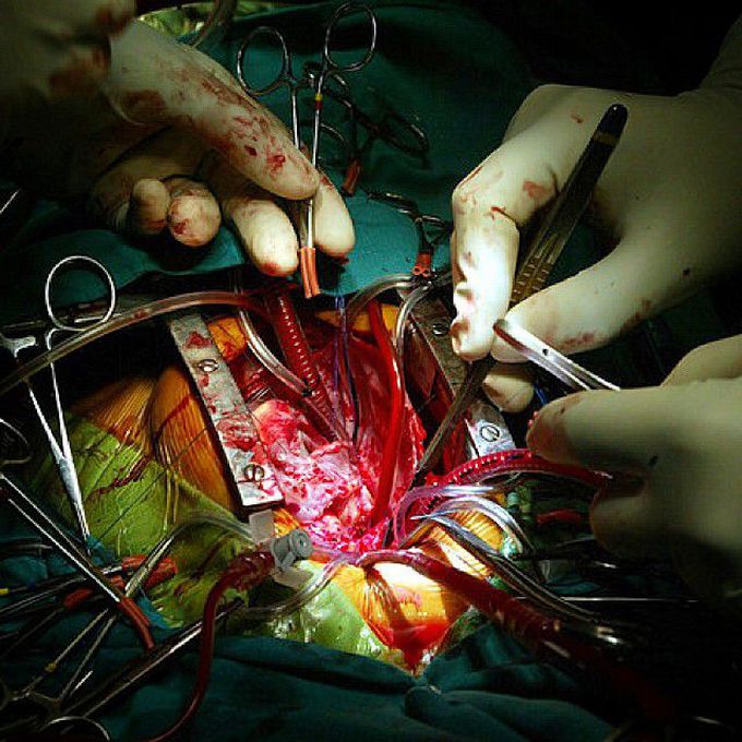 Open heart surgery is carried out on a baby