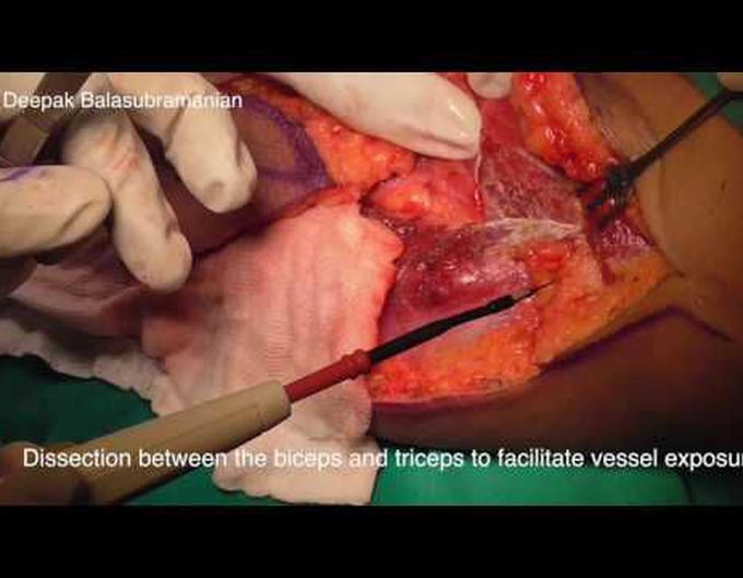 Lateral arm flap
