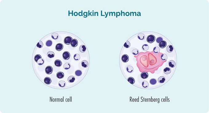 What is hodgkin's lymphoma?