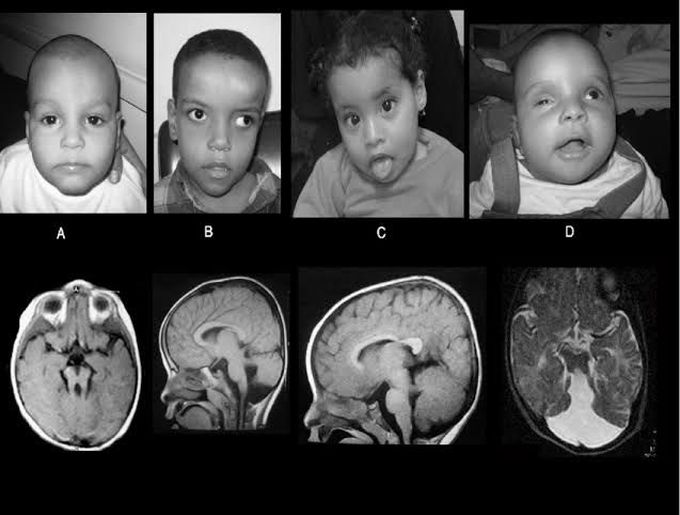 Causes of joubert syndrome