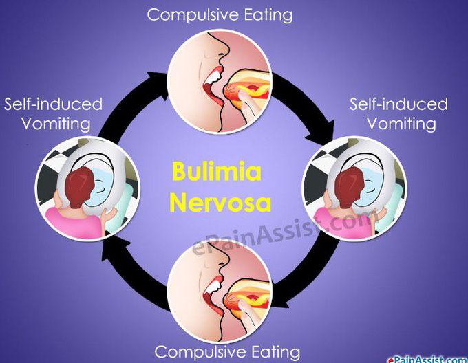 Bulimia Nervosa