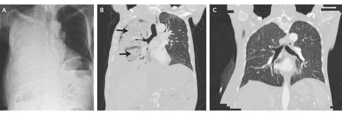 Reexpansion Pulmonary Edema after Thoracentesis