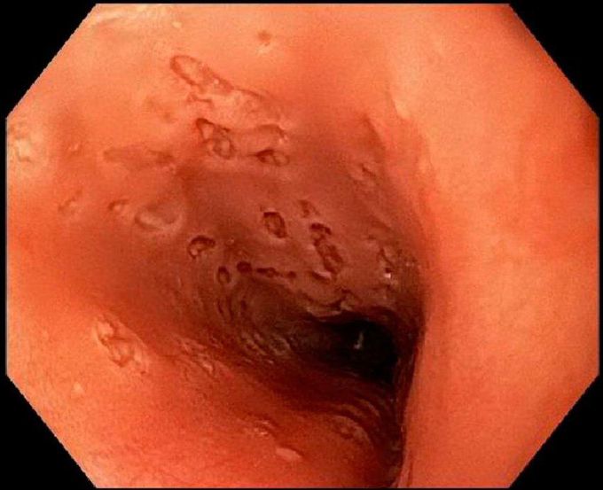 Punched-out Ulcers in Esophagus