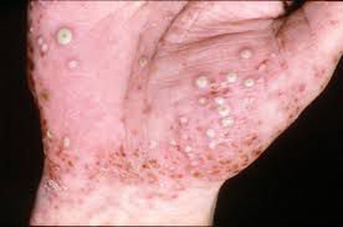 Pustular psoriasis