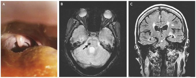 Secondary Palatal Myoclonus