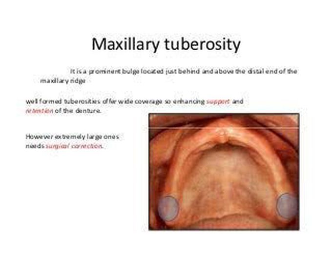 Maxillary tuberosity