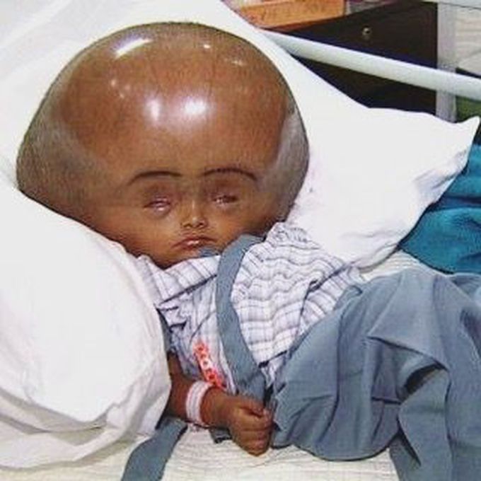 Have you ever seen a head that big before? This is a case of hydrocephalus. 