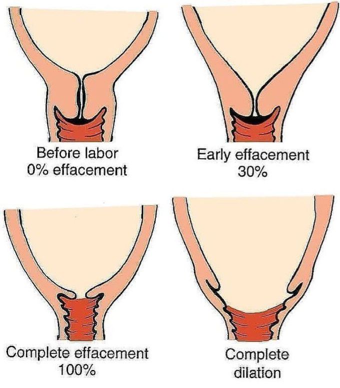 Cervical Effacement