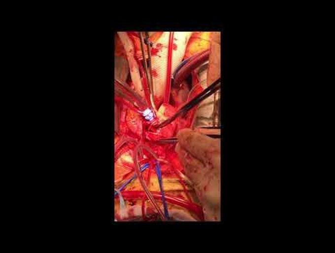 AV Flow Cannula: A New Device for Antegrade Selective Cerebral Perfusion