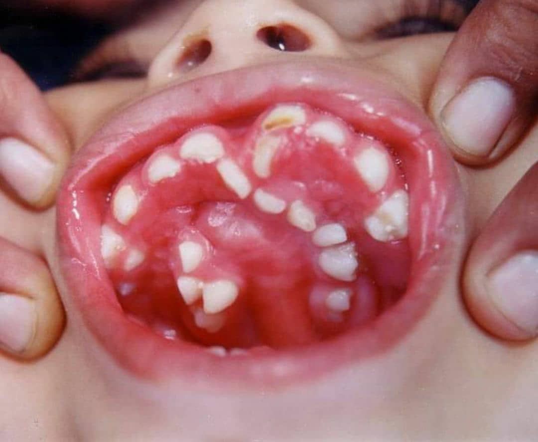 Rare case of a child suffering from a condition called - MEDizzy, image size:1080x887