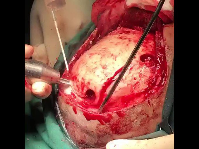 Stroke hemorrhage surgery