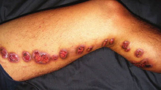 Sporotrichosis