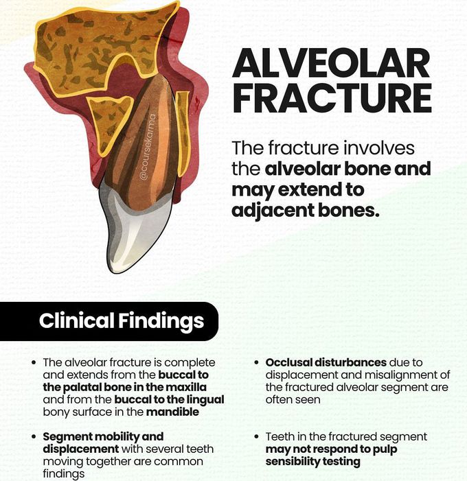 Alveolar Fracture