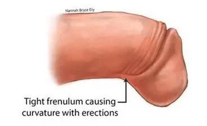 Cause of frenular chordee