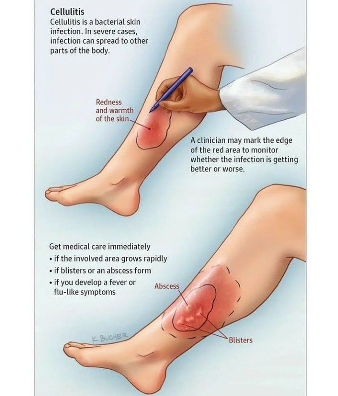 Cellulitis