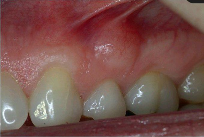 Neurofibroma