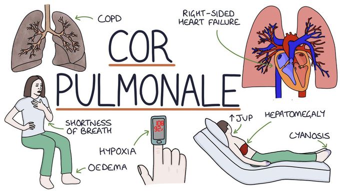 Cause of Cor pulmonale