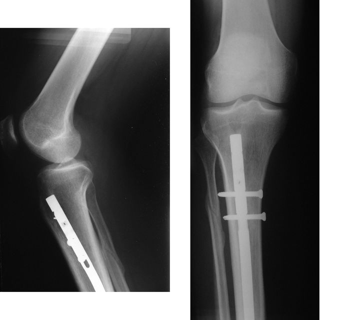 Indications of Intramedullary Nails