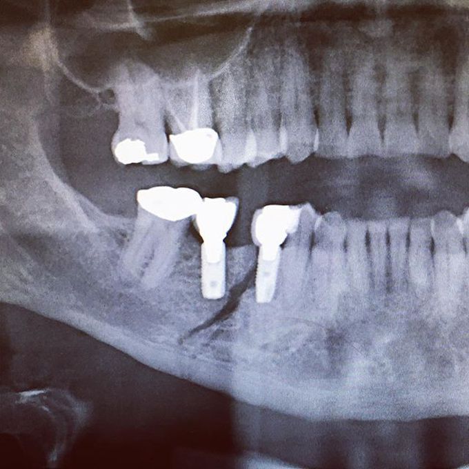 Jaw vs Fist part 1👊😵