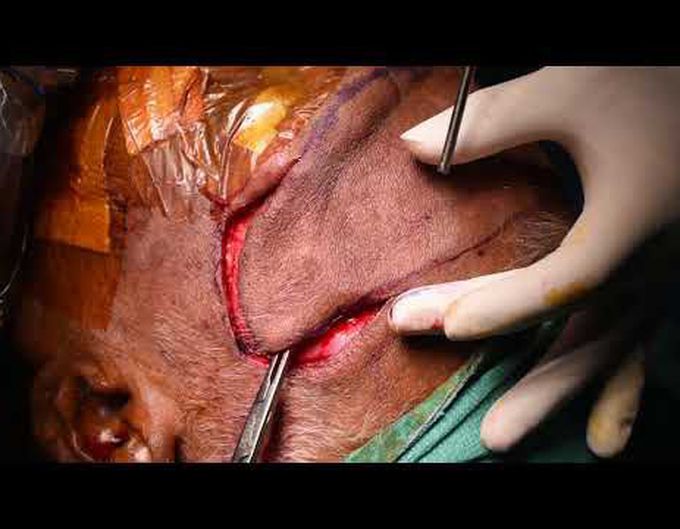 Standard forehead flap