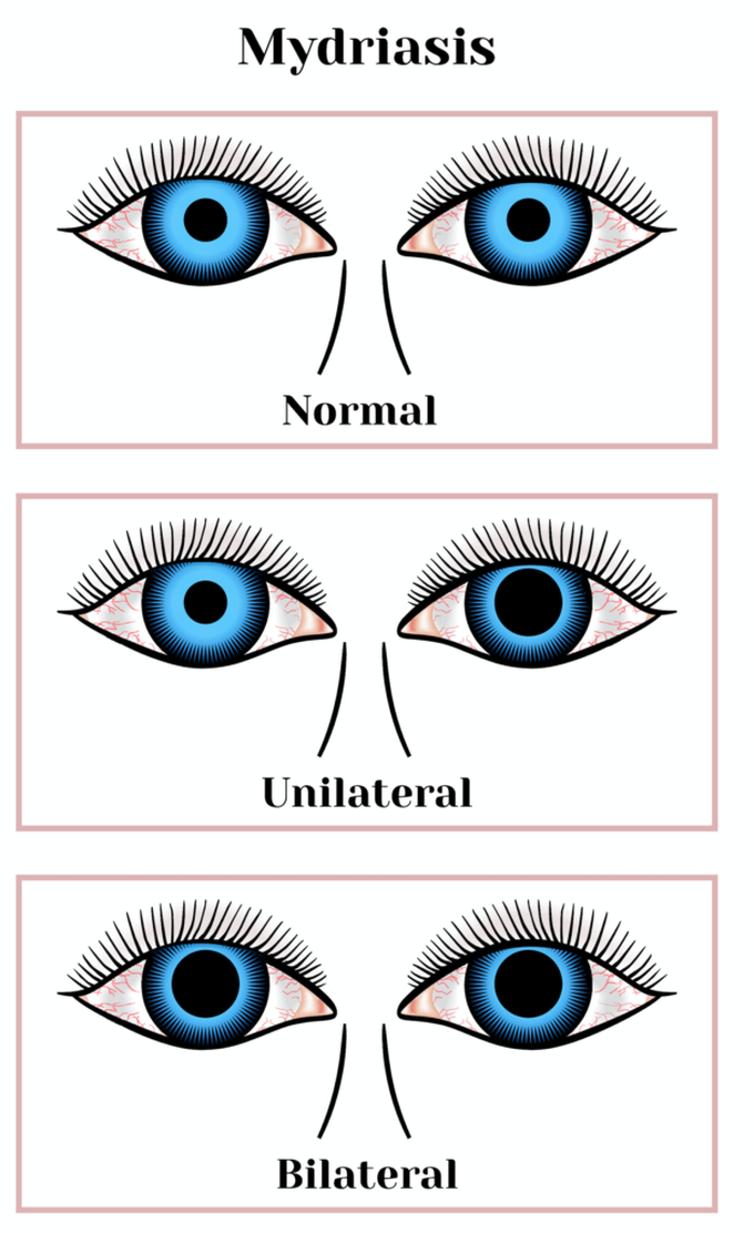 Mydriasis