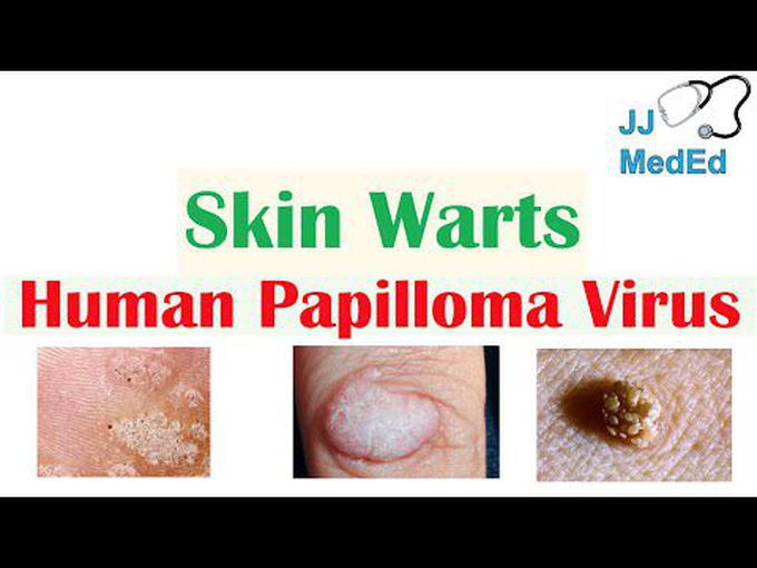 Skin Warts (Verrucae)