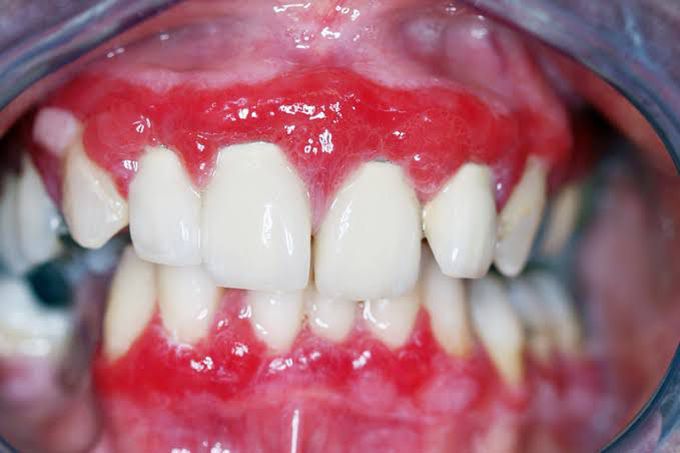 Mucous membrane pemphigoid (MMP)