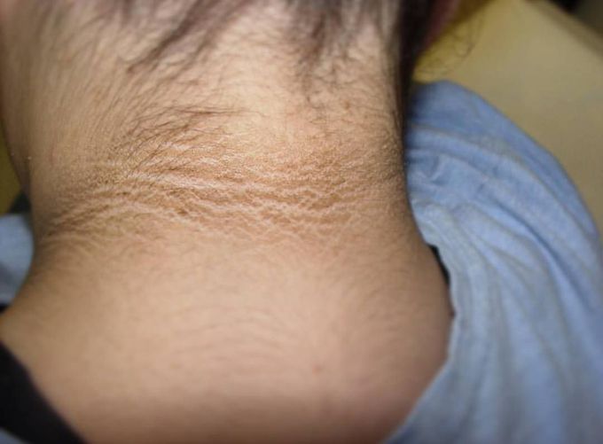 Acanthosis nigricans