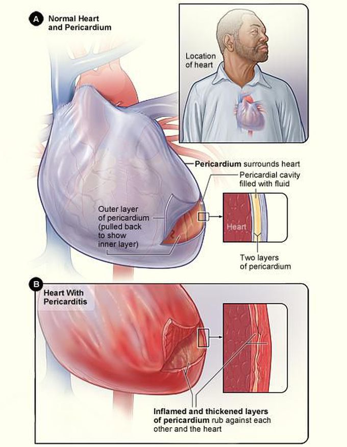 Acute Pericarditis