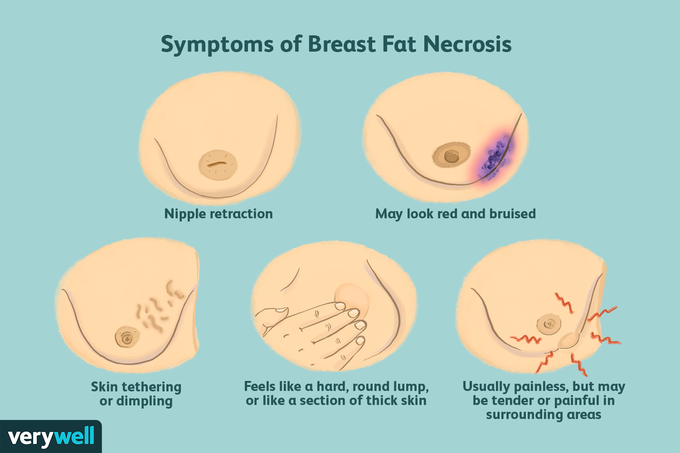 Breast Fat Necrosis