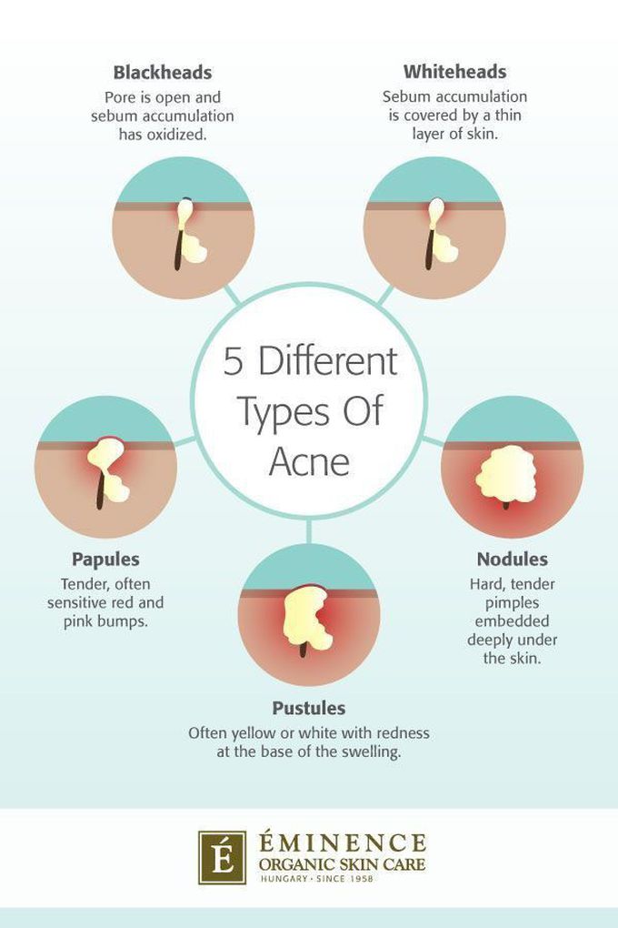 Types of Acne