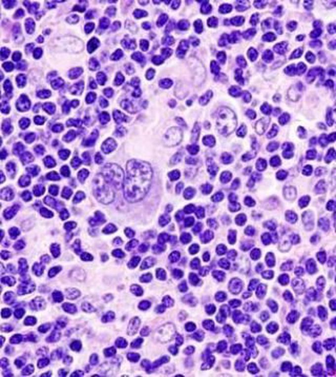 Hodgkin's Lymphoma