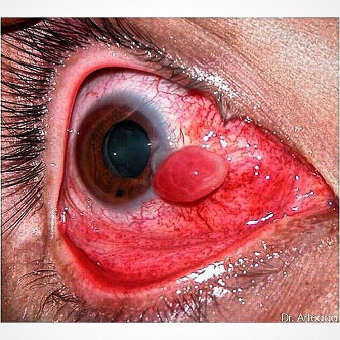 Conjunctival cyst