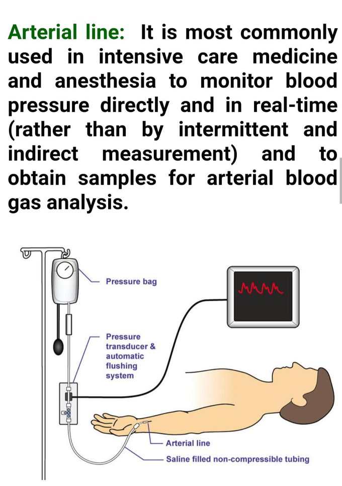 Different Types Of Arterial Lines