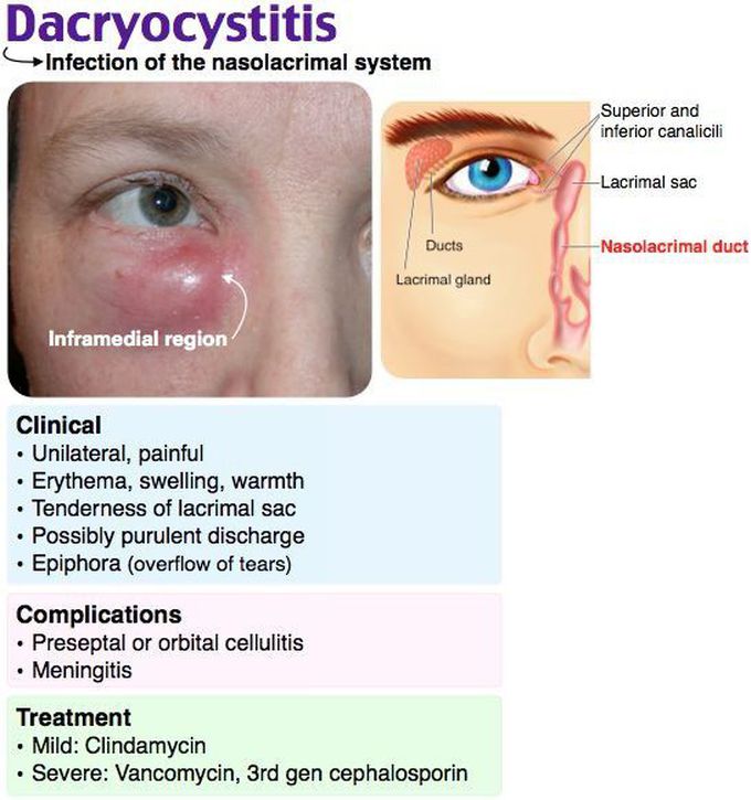 Dacryocystitis (Nasolacrimal system inflammation) 