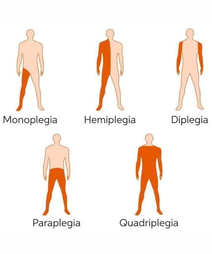 Different Types of Paralysis