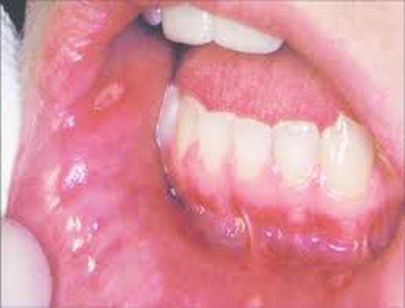 Herpetiform Aphthous Stomatitis Icd 10