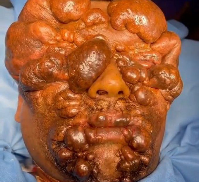 Neurofibromatosis