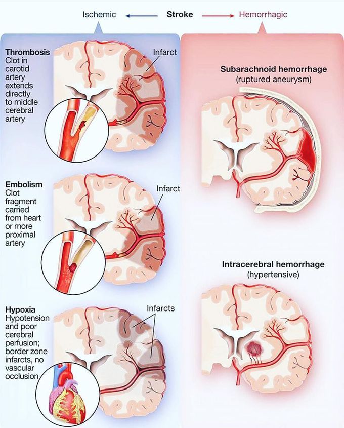 Types of stroke