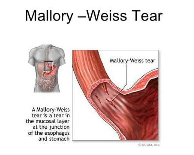 Mallory- weiss tear