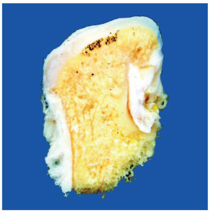 Osteochondroma