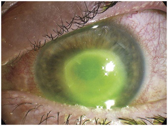 Acanthamoeba Keratitis