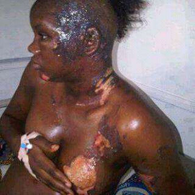 Fire case please your treatment