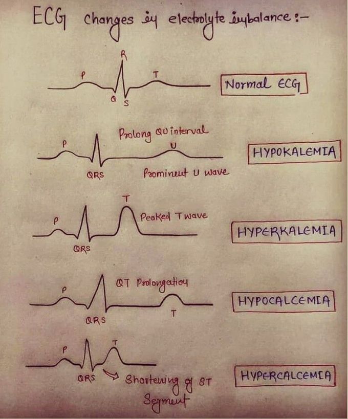 Hypo and hyper kalemia, calcemia